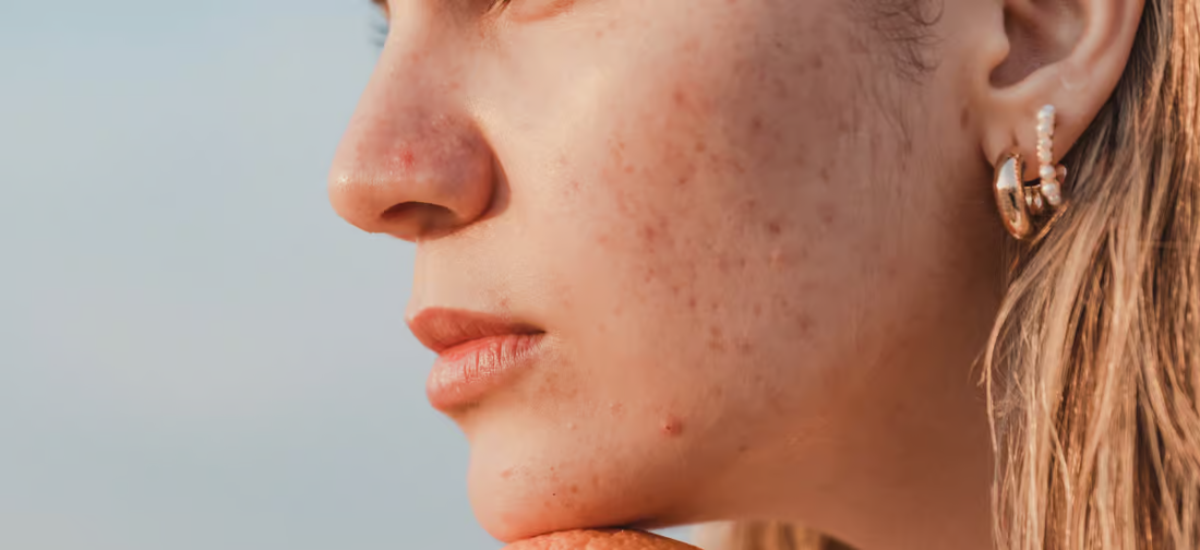 Woman with acne scars on her face||