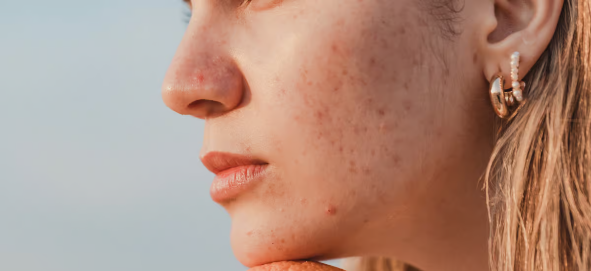 Woman with acne scars on her face||