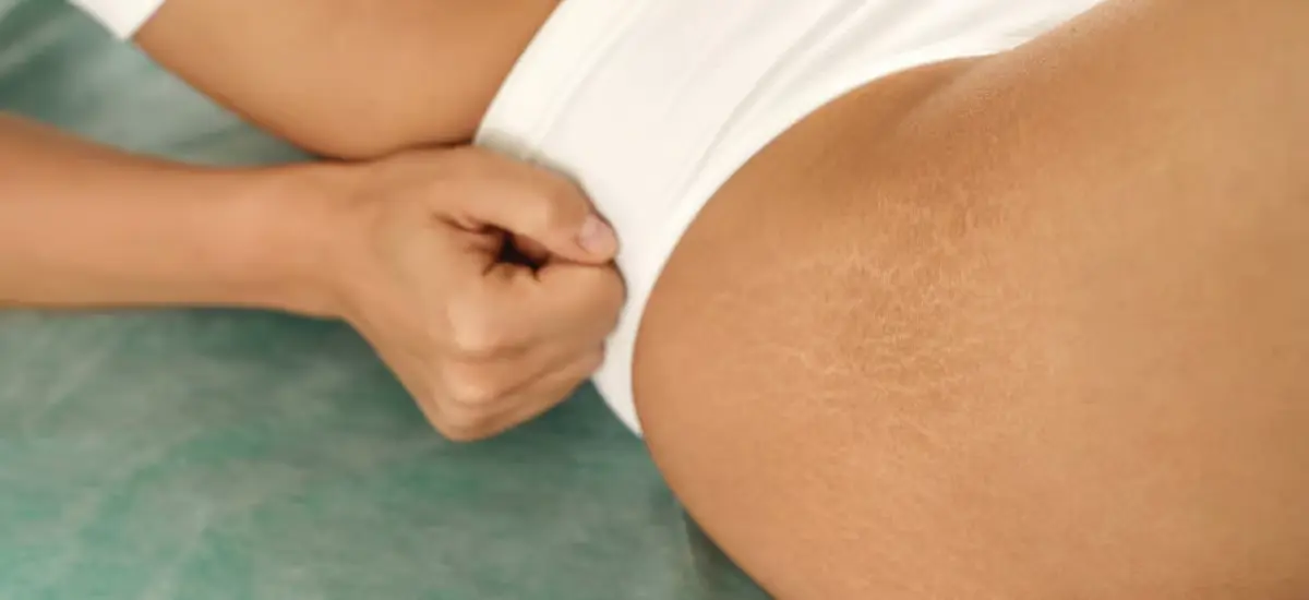 Stretch marks on a woman's thigh