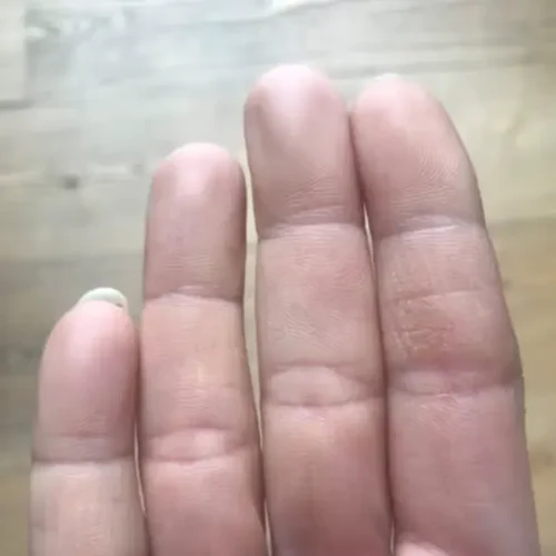 Skin on fingers healed after collagen treatment