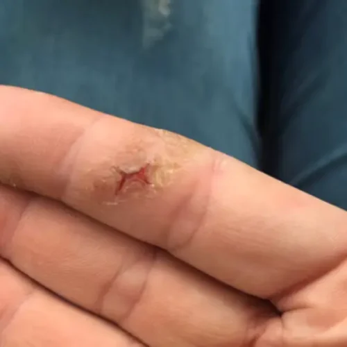 Wound on finger before collagen treatment