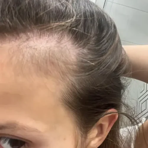 Scalp with thinning hair