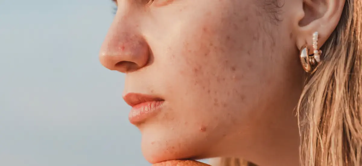 Woman with acne scars on her face