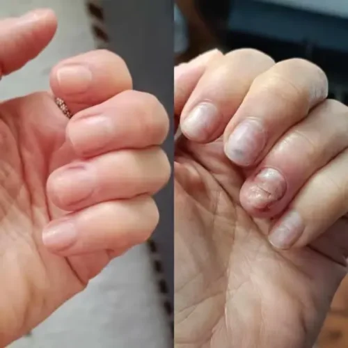 Nails before and after collagen treatment