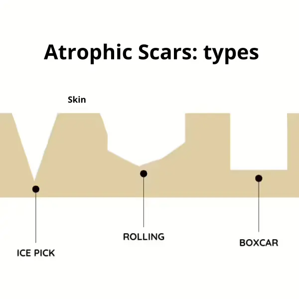 Types of atrophic scars